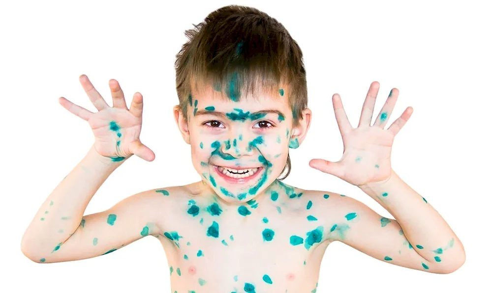 Chickenpox apma