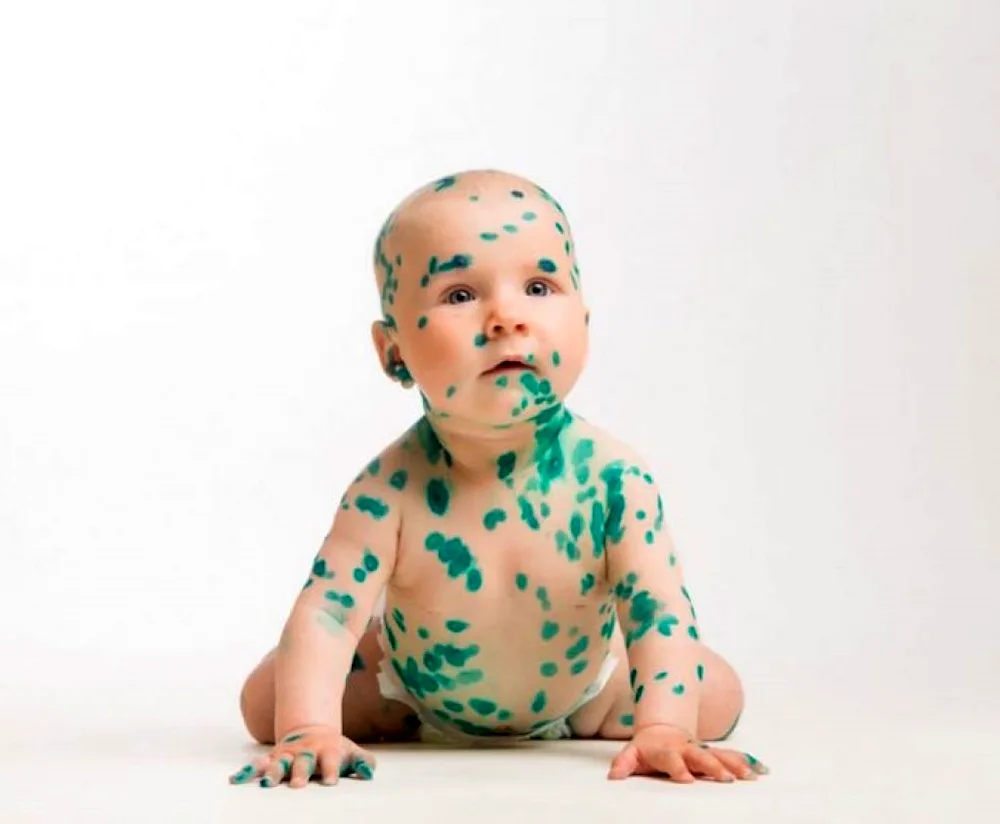 Rash chickenpox