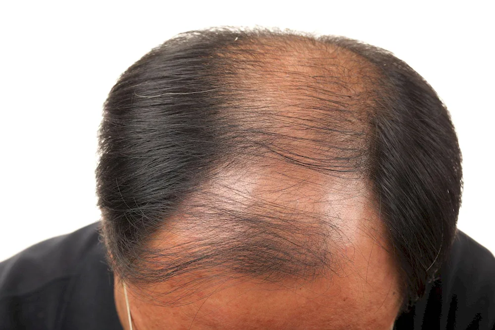 Hair slicked back on baldness
