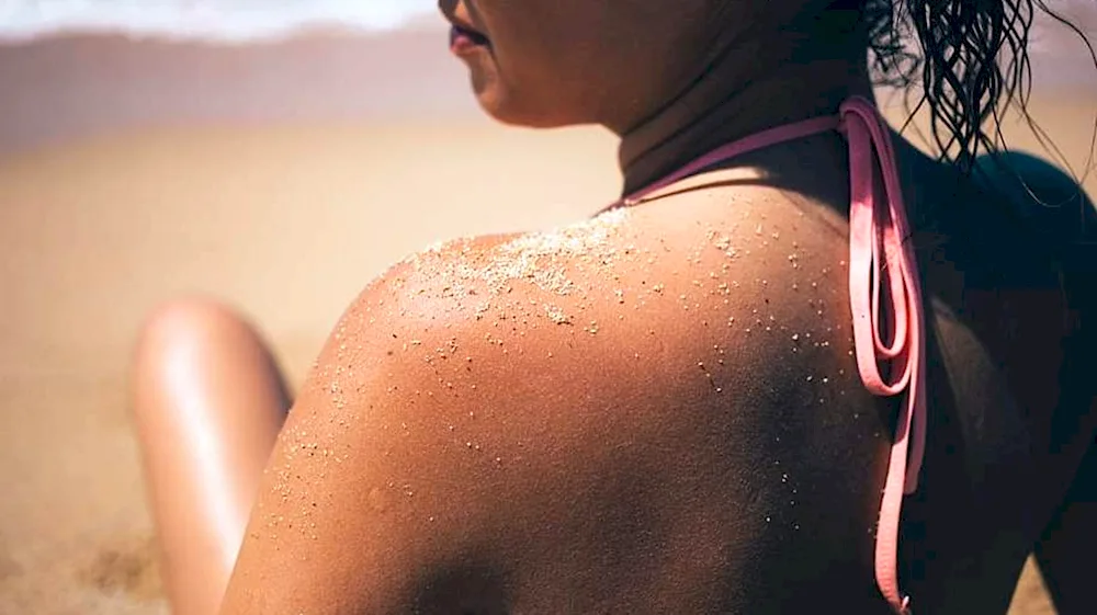 Sunburn on the beach