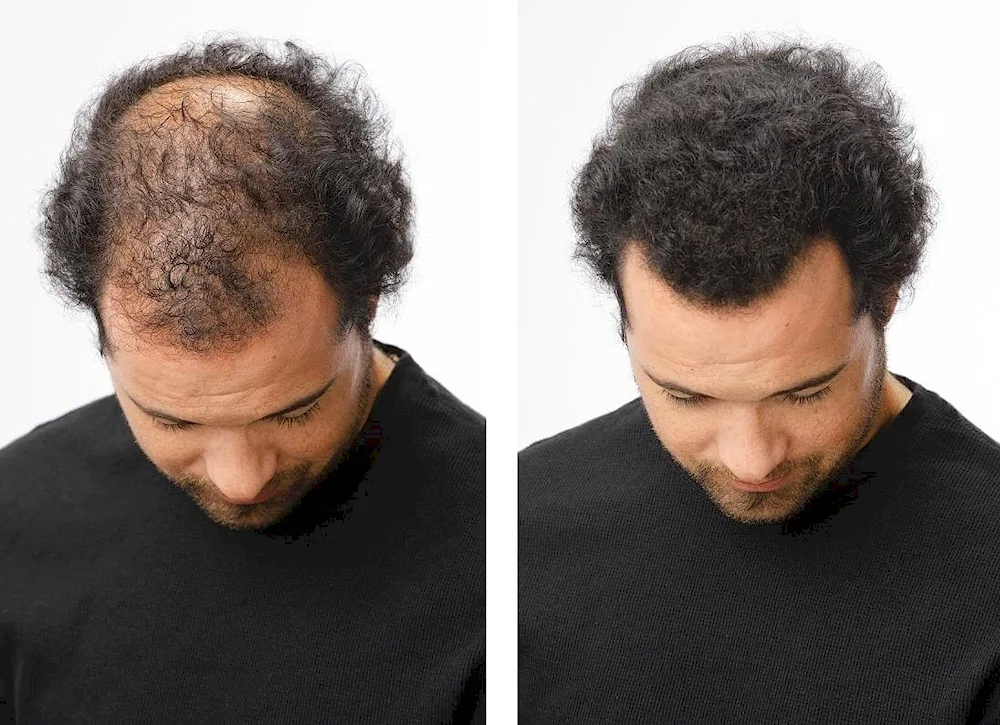 Men's hairstyles with bald spots