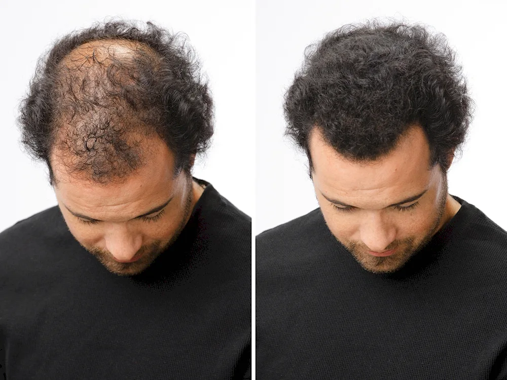 Caboki hair thickener