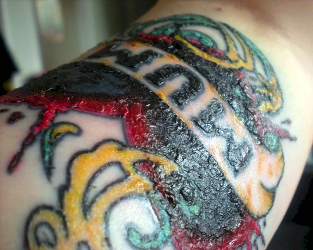 Healing a coloured tattoo