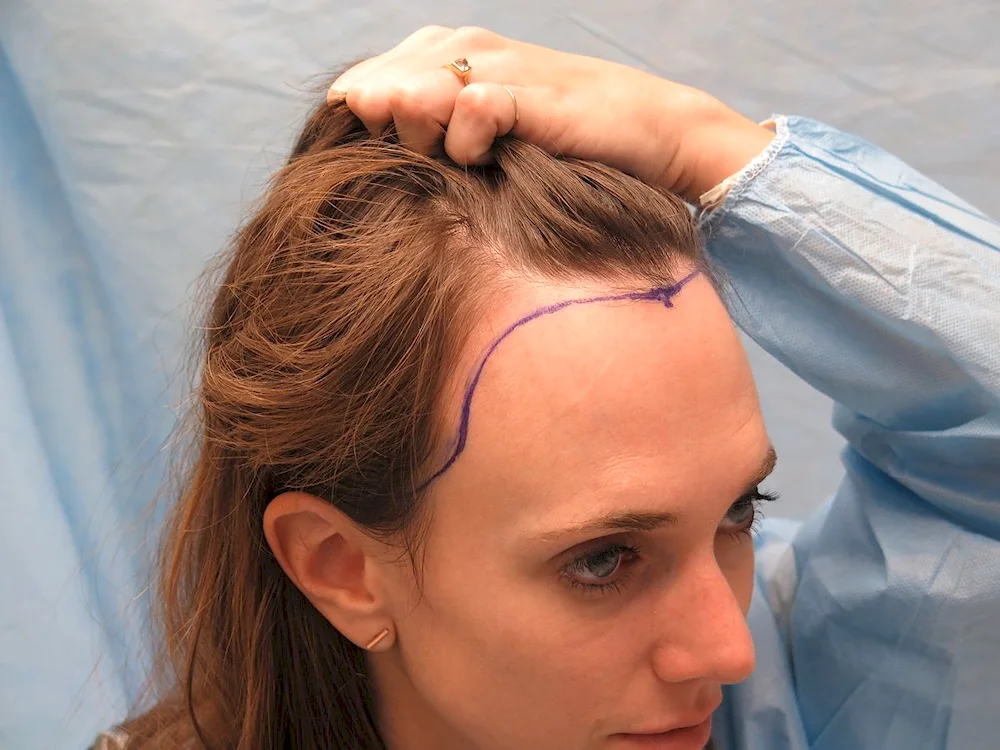 Androgenetic alopecia Hamilton