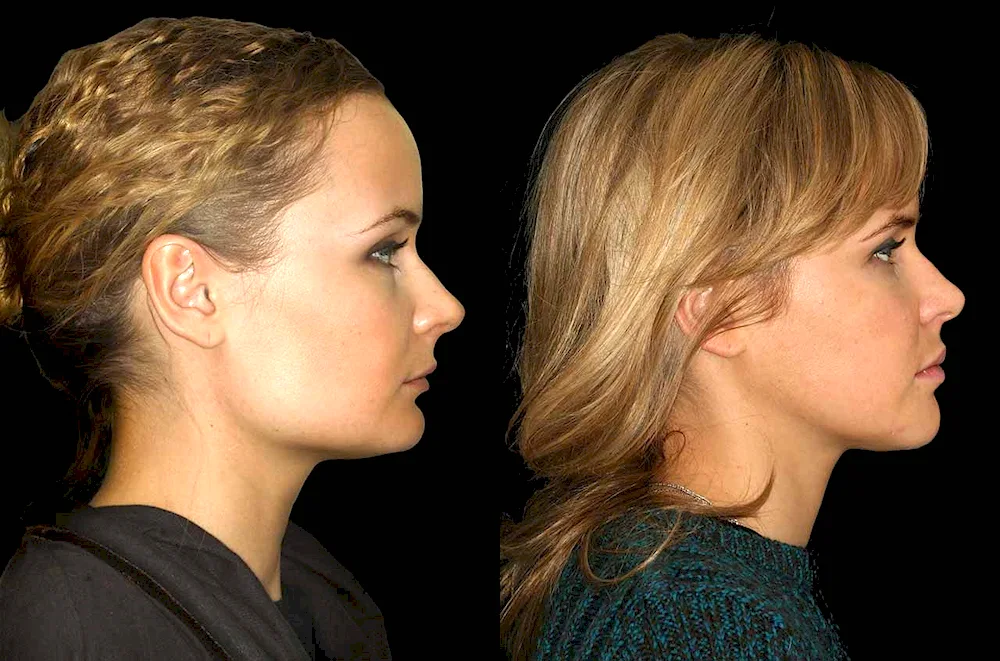 Genuine chin